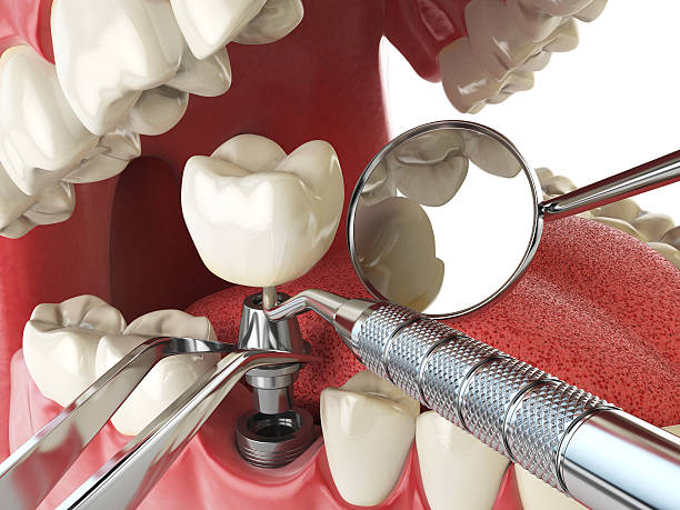 Best Emergency Root Canal Treatment in Upton, WY